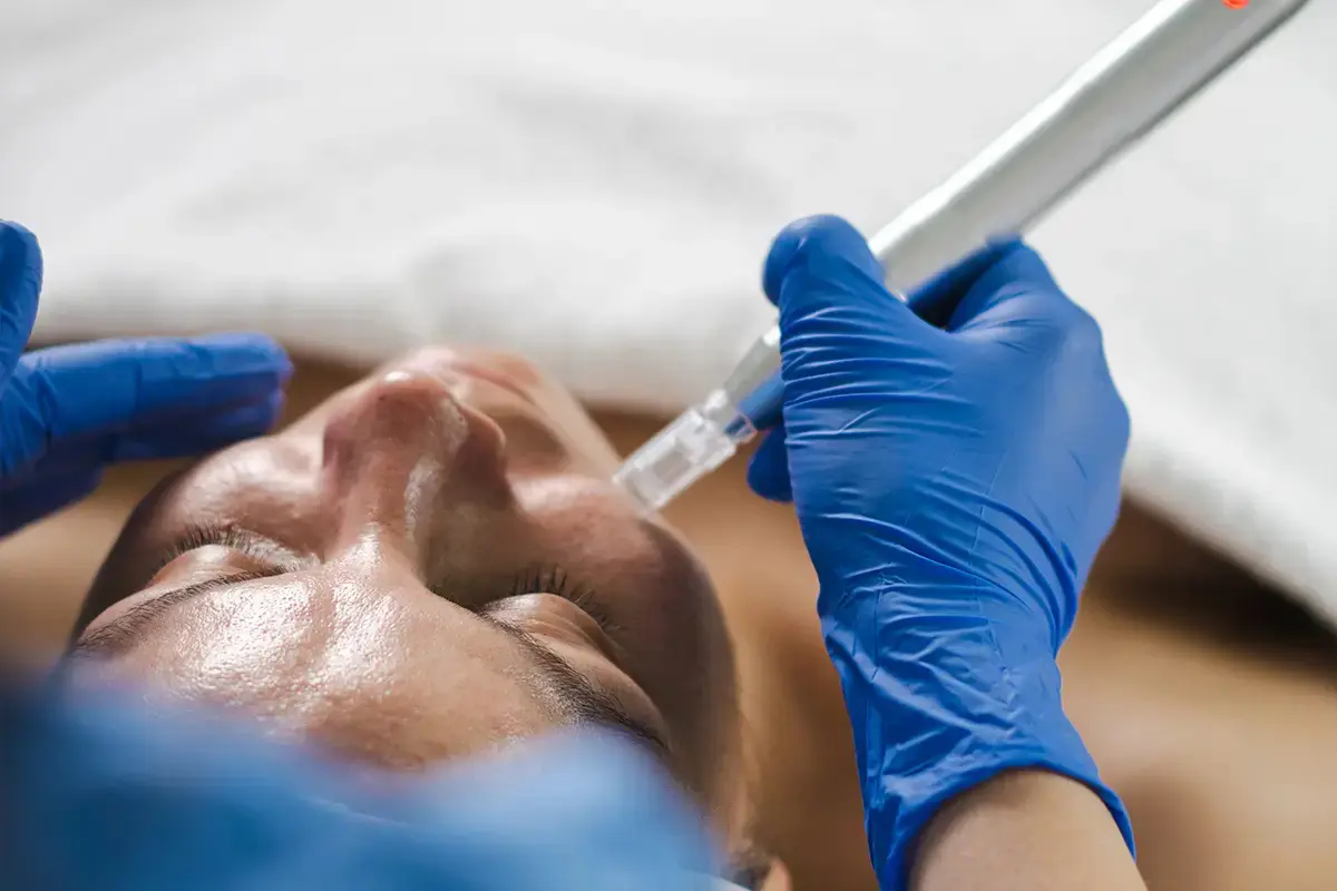 Este microneedling sigur pentru cicatrici acnee?